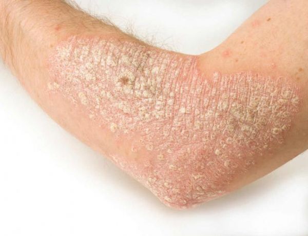 MEDICAMENTO EXPERIMENTAL ES EFECTIVO CONTRA LA PSORIASIS