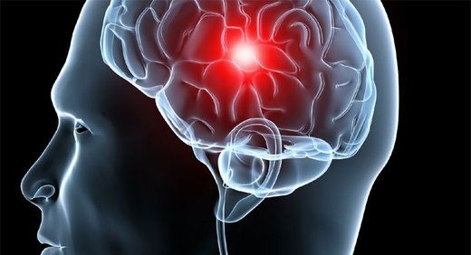 29 DE OCTUBRE, DÍA MUNDIAL DEL ACCIDENTE CEREBRO VASCULAR (ACV)