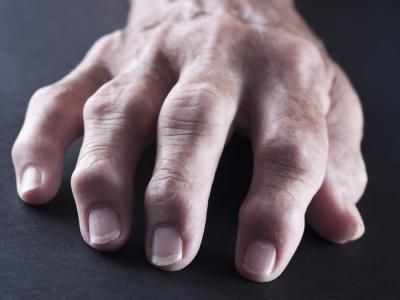 DESCUBREN UNA NUEVA FORMA DE TRATAR LA ARTRITIS