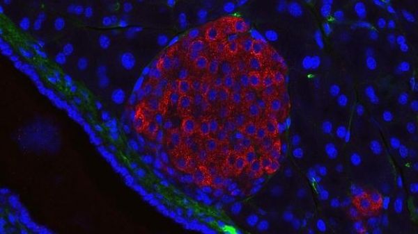 LA DIABETES SE PUEDE REVERTIR CON LA PÉRDIDA DE UN ÚNICO GRAMO DE LA GRASA DEL PÁNCREAS