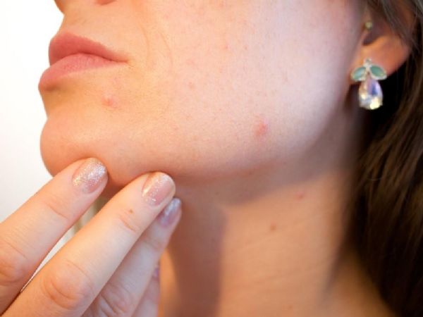 10 COSAS QUE NO SABÍAS SOBRE EL ACNÉ